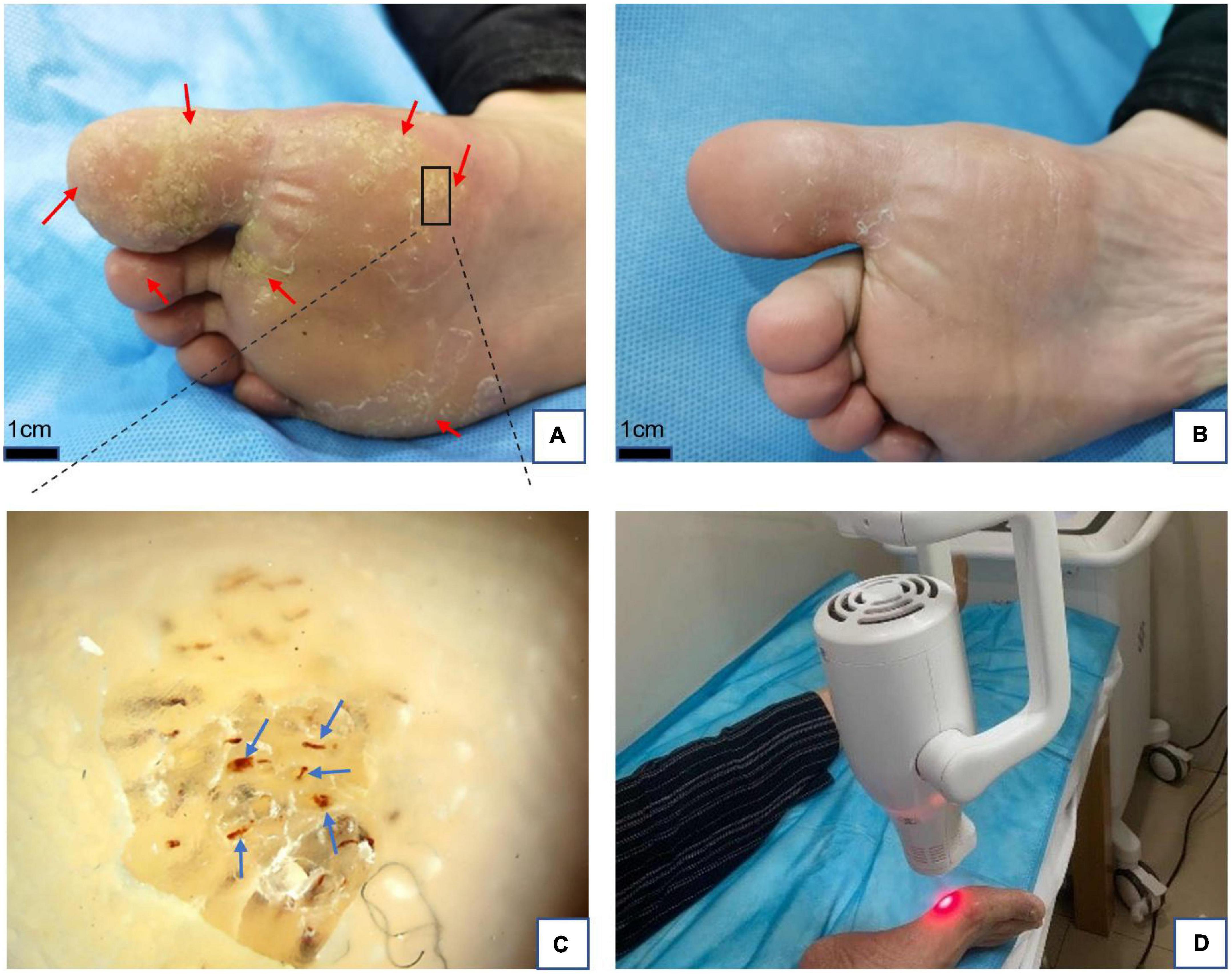 Clinical observation and study of local hyperthermia for treating plantar warts: A pilot study with 38 patients